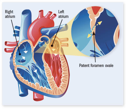 illustration showing a human heart with a patent foramen ovale (a small opening between the upper chambers) as described in the article text