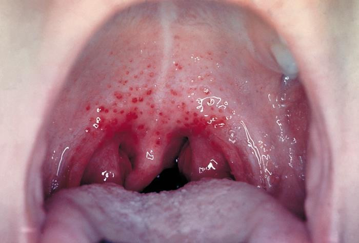 close-up photo of a person's mouth and throat showing symptoms of strep throat