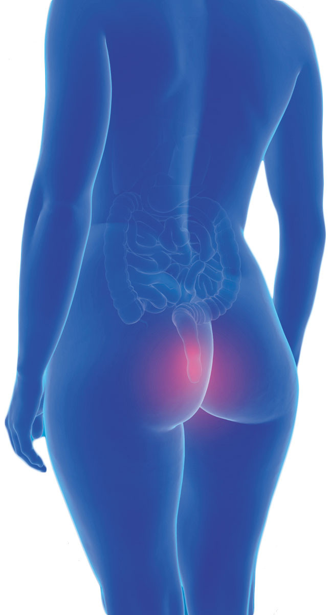 illustration of a human body viewed from behind; the skin is translucent blue and the digestive system is visible, with red highlighting the anal area to represent hemorrhoids