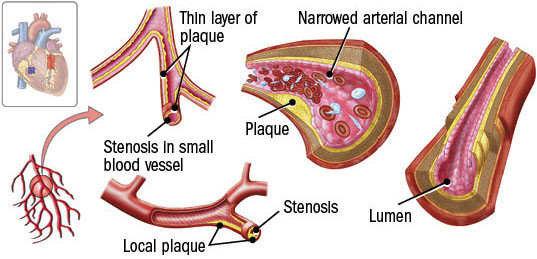 illustration showing how coronary microvascular disease affects some of the heart's smallest blood vessels