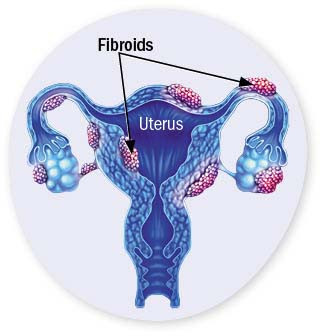 illustration of a female uterus and ovaries showing where fibroids can develop
