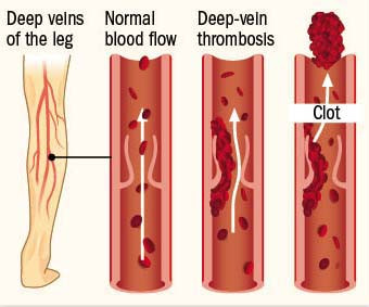 illustration showing a vein with normal blood flow and one with deep-vein thrombosis, which can lead to a clot