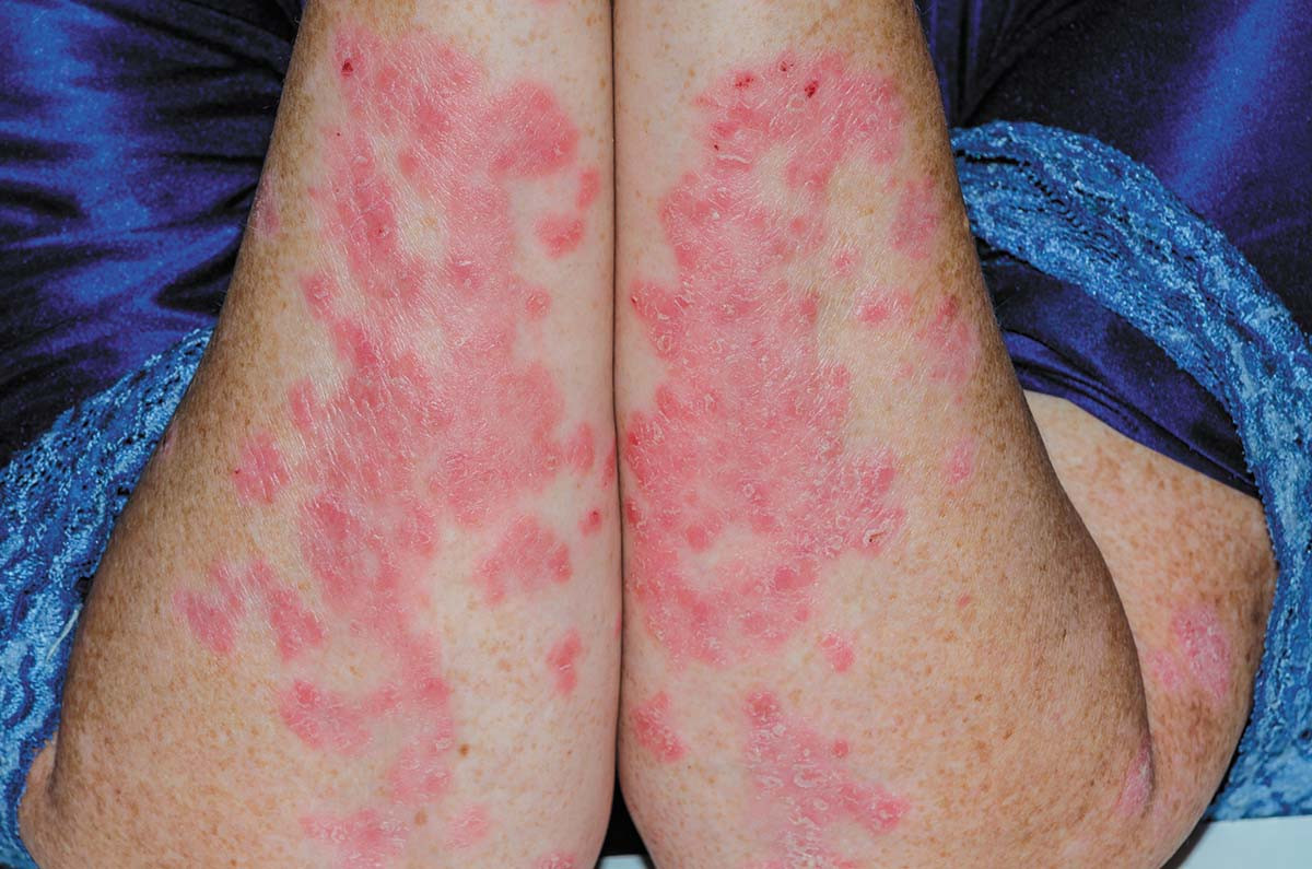 cropped photo showing the arms of a person with psoriasis; arms are held in front of the torso so thered patches of skin on the arms are visible