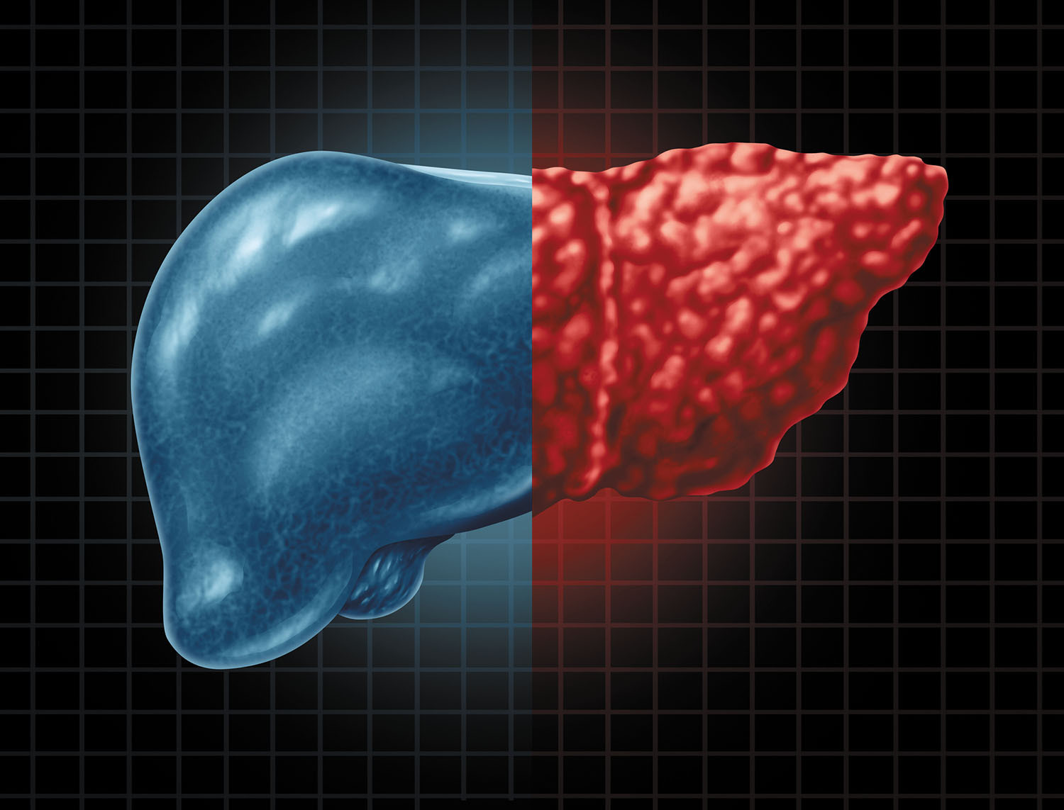 photo illustration using medical imaging showing a human liver, the left half is healthy and is tinted blue while the right half shows fatty liver disease and is tinted red