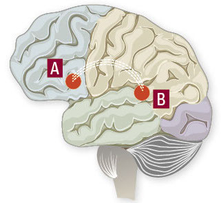 illustration of a human brain with its regions highlighted in different colors, with sections marked A and B corresponding to types of aphasia described in the story