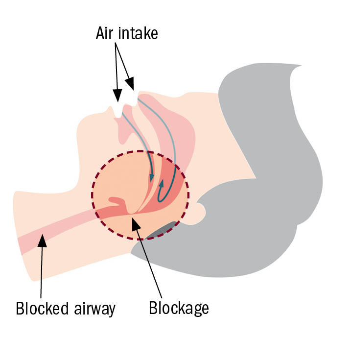 illustration of the head and neck of a person sleeping showing how a blocked airway can cause sleep apnea