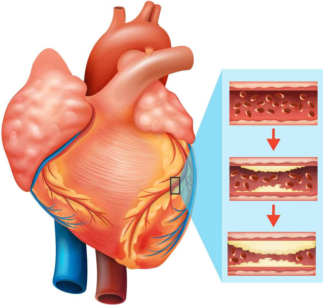 illustration of a heart with a magnified section showing how plaque can build up in arteries