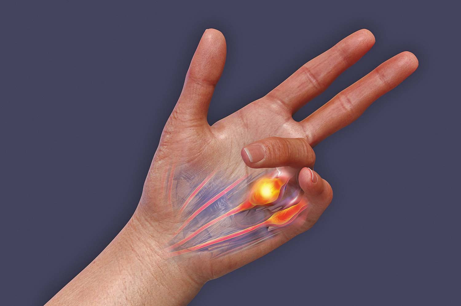 illustration showing Dupuytren's contracture pulling third and fourth fingers toward the palm of a hand; palm is translucent and shows a glowing lump that causes the pull