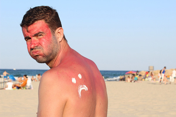 photo of a man at a beach with a serious sunburn, he is standing with his back to the camera and looking over his left shoulder with an unhappy look; there is a sad face drawn on his left shoulder blade in white sunscreen