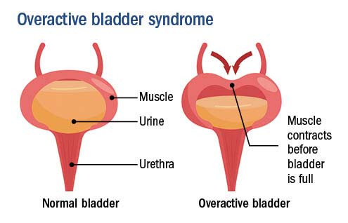 illustration showing behavior of a normal bladder versus an overactive bladder, with bladder muscle contracting before the bladder is full