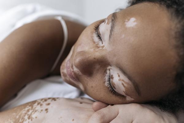 close-up photo of a woman with vitiligo sleeping, with areas on her eyelids, around her mouth, and on the backs of her hands