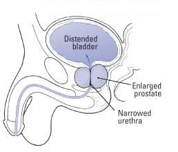 Enlarged Prostate (Benign Prostatic Hyperplasia) Guide: Causes ...