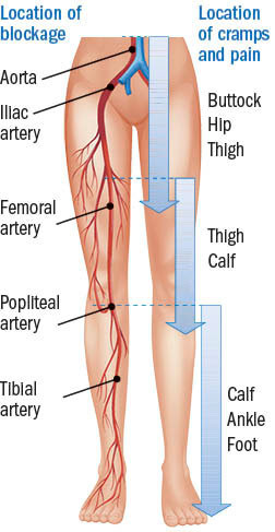 illustration of the lower body showing arteries affected by peripheral artery disease, and locations of pain or cramps caused by it