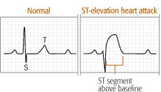 Electrocardiogram (EKG) - Harvard Health