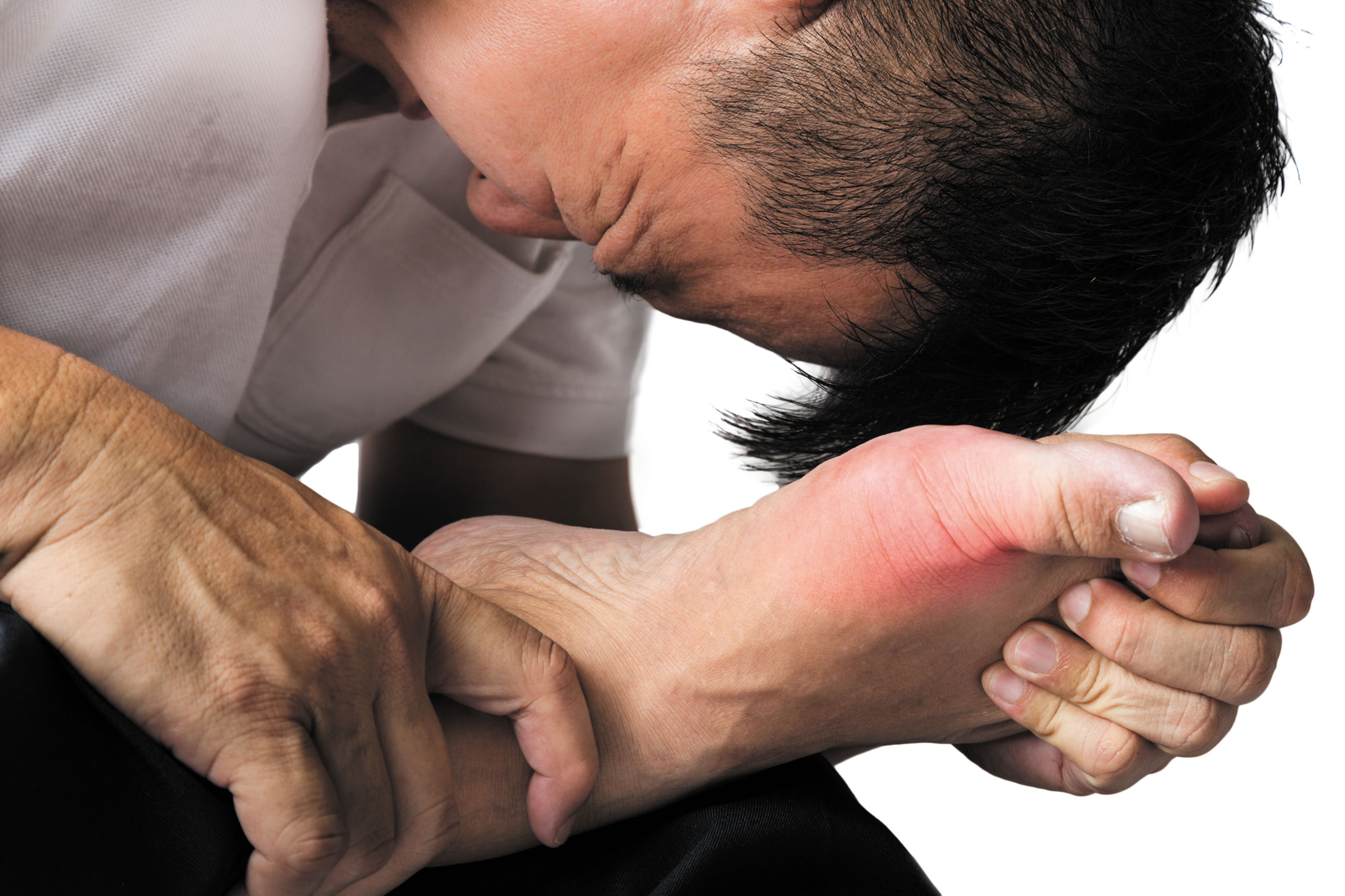 Image for النقرس: ما هو، الأعراض، العلاج، وكيفية الوقاية منه